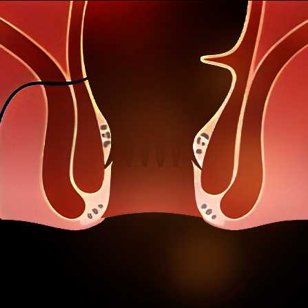 Anal Fistula surgery